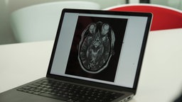 Das Bild zeigt einen Laptop auf einem Tisch. Auf dem Bildschirm ist ein CT-Scan zu sehen. 