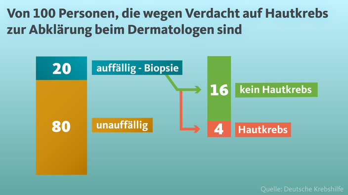 Grafik: Von 100 Personen, die einen Verdacht auf Hautkrebs beim Dermatologen prüfen lassen, ist das Ergebnis bei 80 unauffällig. Bei den übrigen 20 wird eine Biopsie durchgeführt. Bei 16 davon wird kein Hautkrebs, bei 4 Hautkrebs festgestellt.