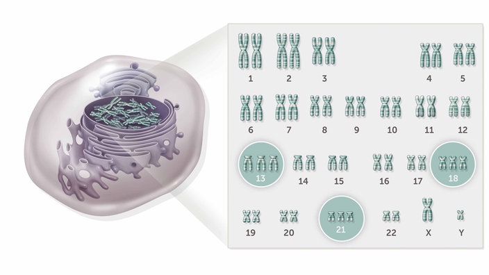 Darstellung der verschiedenen Trisomien auf einer genetischen Karte